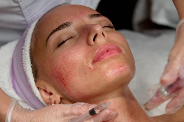 Dealing with Extreme Swelling After Microneedling