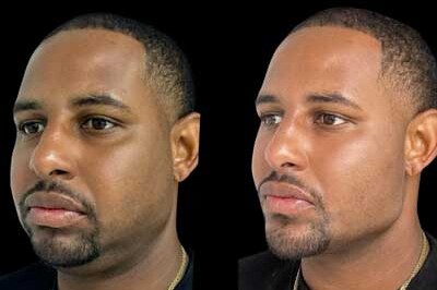 Facial Harmonization miami