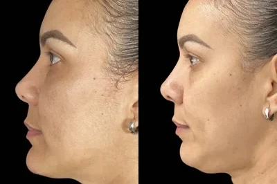 Facial Harmonization miami