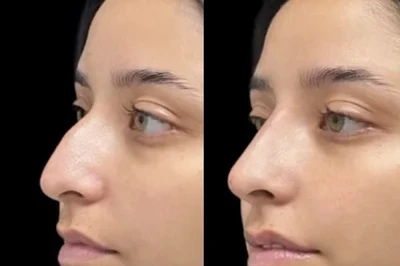 Non-Surgical Nose Job miami