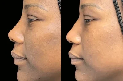 Non-Surgical Nose Job miami