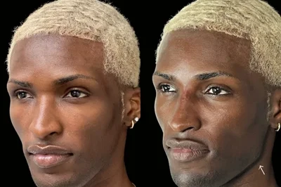 Facial Harmonization miami