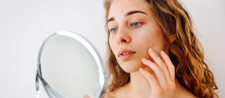 Does Collagen Help With Acne