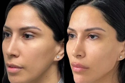 Facial Harmonization miami 04