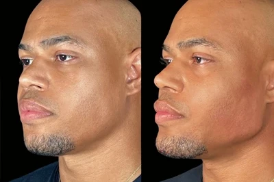 Facial Harmonization miami 06