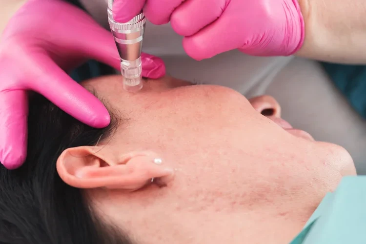 Microneedling for Acne Scars