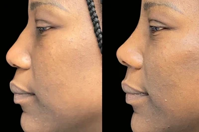 Non Surgical Nose Job miami 01