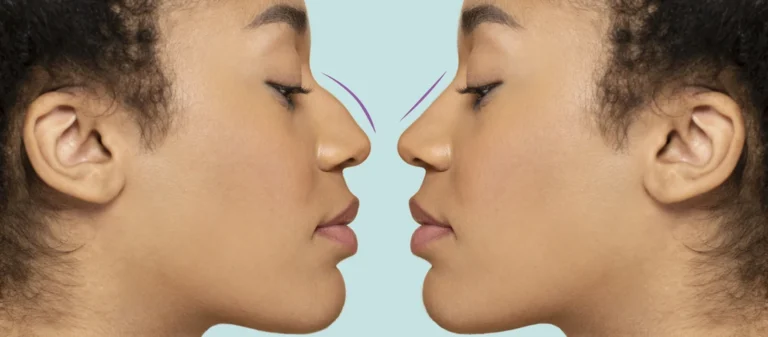 Bulbous Nose Tip Without Surgery