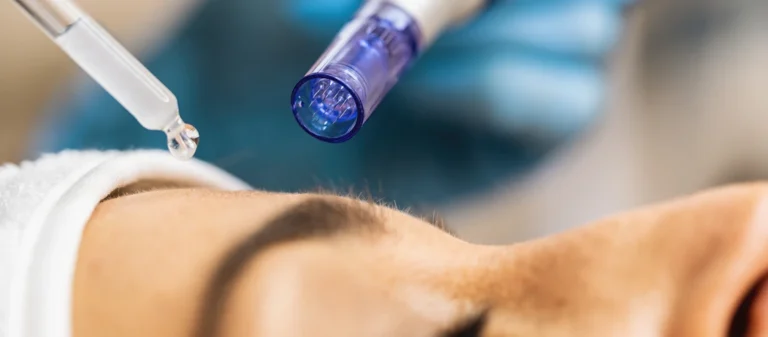 How to Treat Breakouts After Microneedling