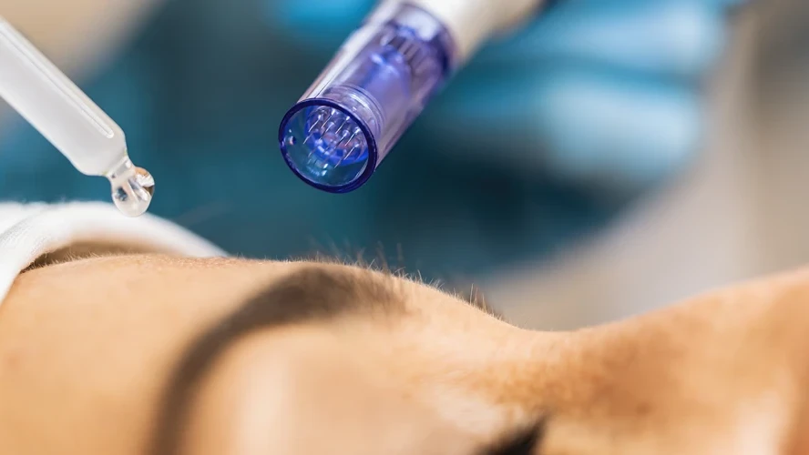 How to Treat Breakouts After Microneedling