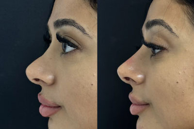 Non Surgical Nose Job Miami