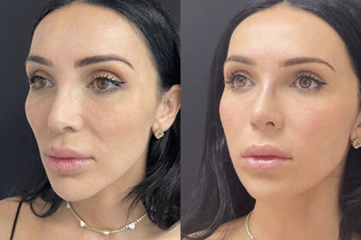 Non Surgical Nose Job Miami 04