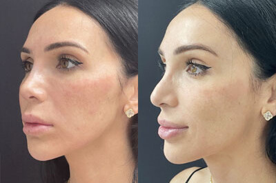 Non Surgical Nose Job Miami 05