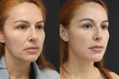 Facial Balancing miami 03