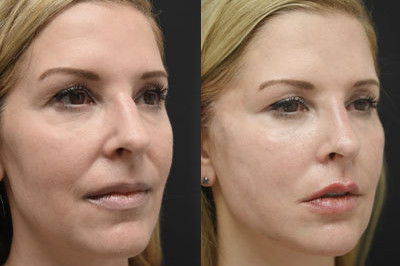 Facial Balancing miami 04