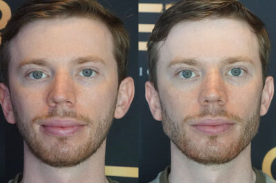 Facial Balancing miami 07