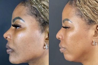 Facial Balancing miami 08