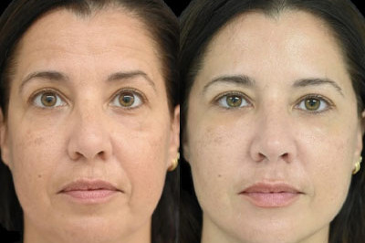 Facial Balancing miami 09