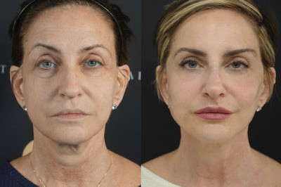 Facial Balancing miami 11