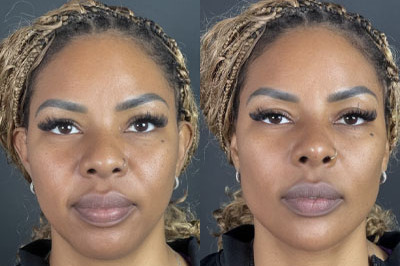 Facial Balancing miami 12