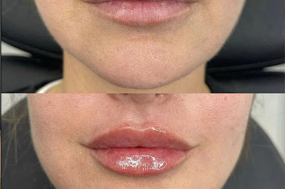 Lip Filler Miami 10