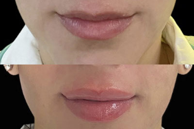 Lip Filler Miami