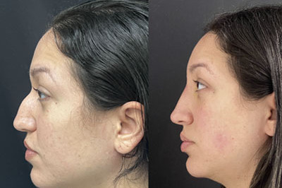 Non Surgical Nose Job Miami 10