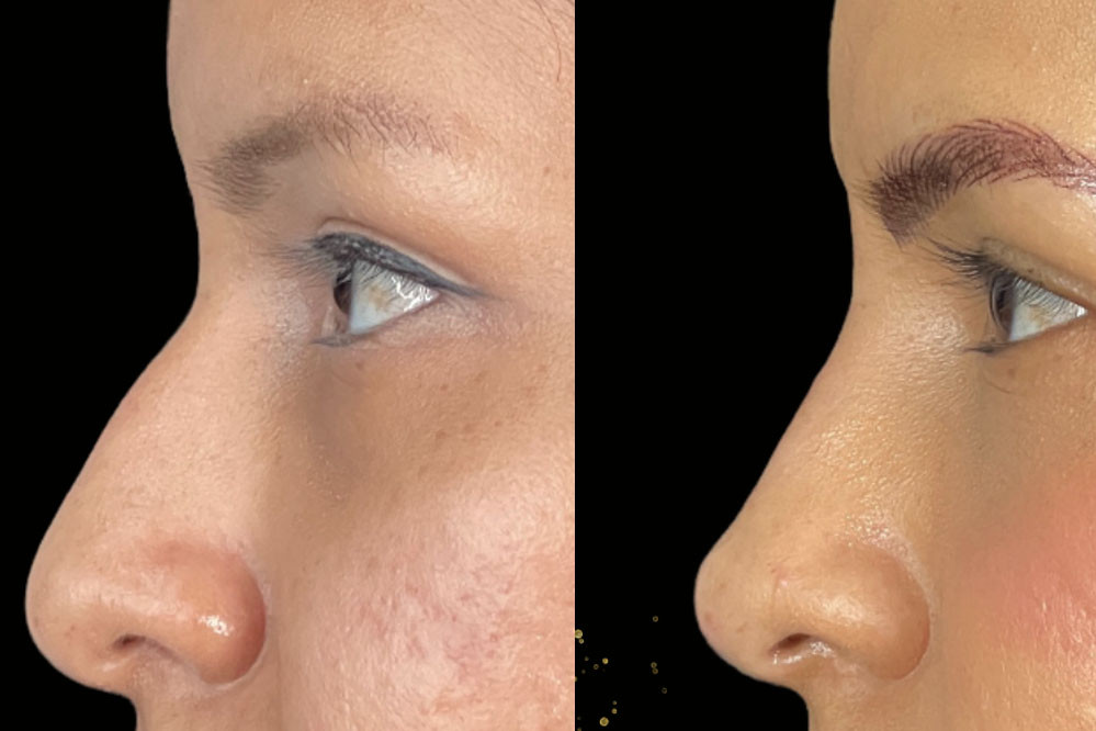 Non Surgical Nose Job Miami 24