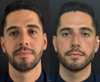 Facial Balancing west palm beach