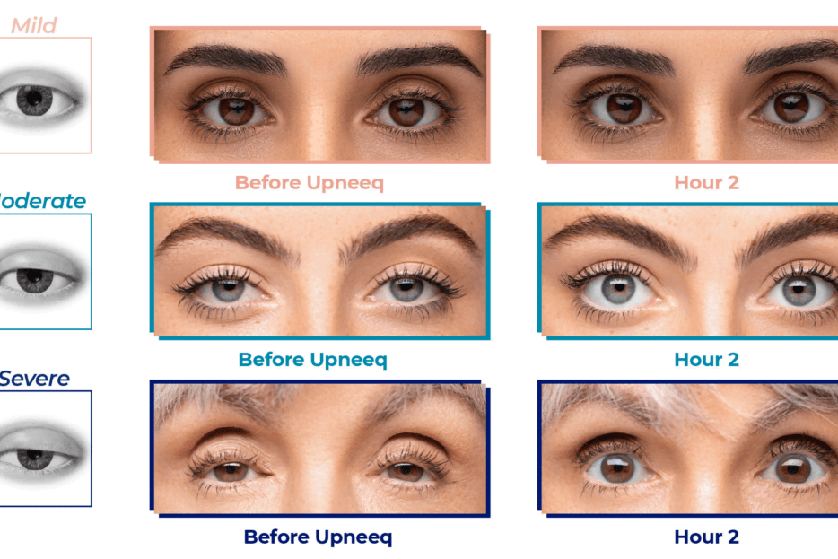 upneeq eye drops uai