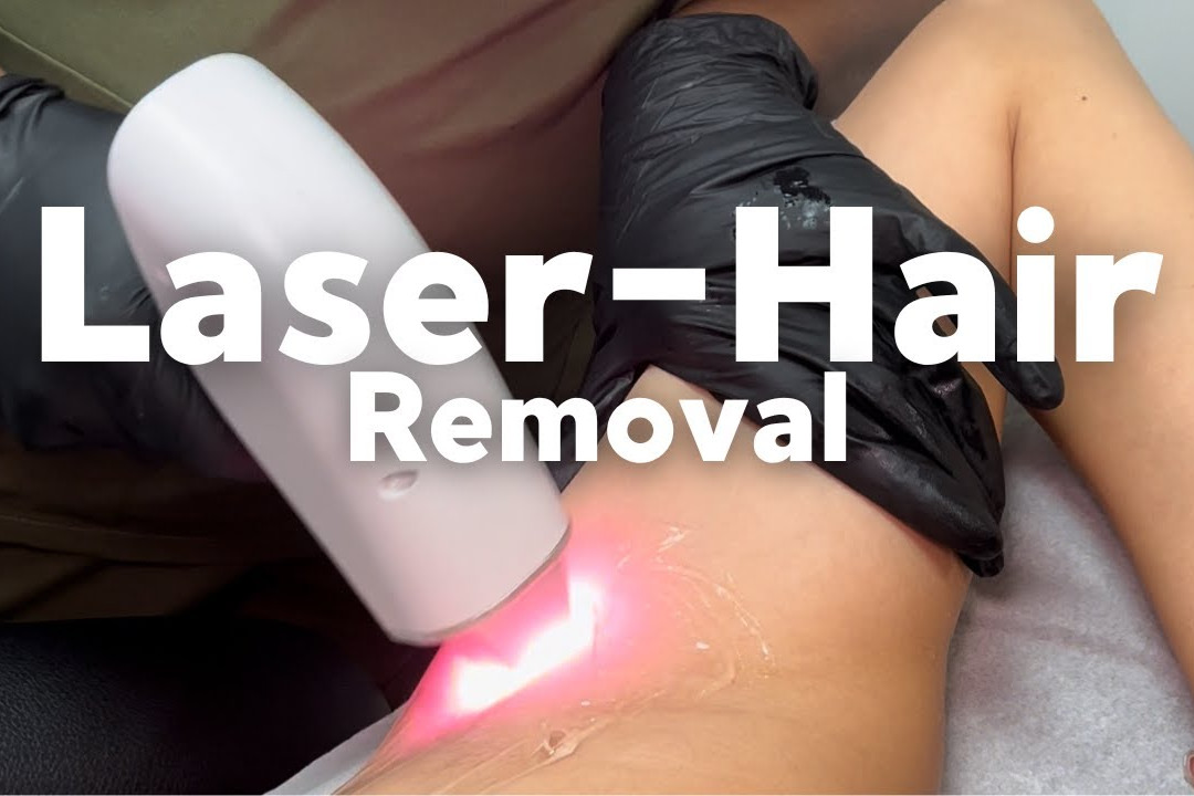 laser hair removal uai